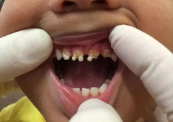 5岁男孩乳牙全毁，“凶手”究竟是谁？