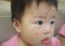 原创| 水痘VS手足口，宝宝远离传染性疾病
