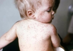 儿童常见疾病——风疹