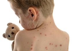 儿童常见疾病——水痘