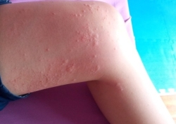 儿童常见疾病——荨麻疹