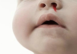 儿童常见疾病——流鼻血