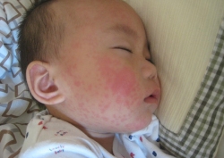 宝宝患上幼儿急疹，发烧呕吐是空调病？需警惕高热惊厥
