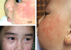 怎样区别小儿麻疹、风疹和幼儿急疹？
